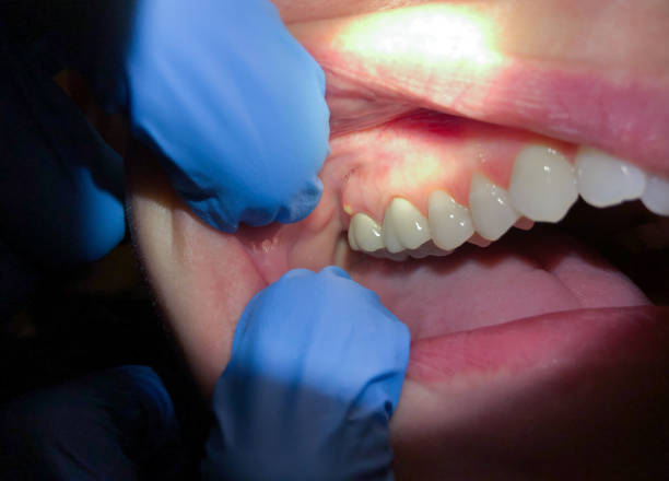 Best Emergency Treatment for Toothache in Elkins Rk, PA